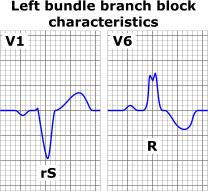 lbb Left_bundle_branch_block_ECG_characteristics